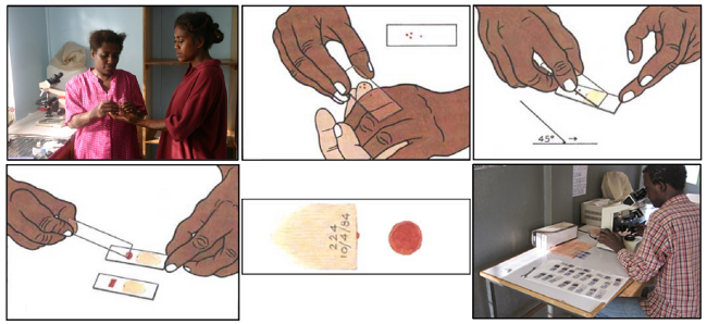 疟原虫检测的血涂片工作流程